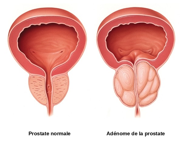 Schéma comparant une prostate normale et une prostate augmentée de volume (adénome) qui comprime le canal de l'urètre